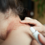 Topical Corticosteroids (steroids) Market to Grow at a CAGR of 5.8% by 2023