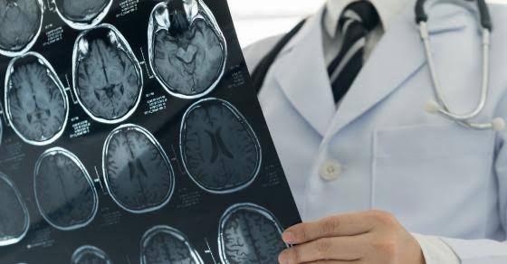 images (18) Silent strokes common than overt ones in older patients