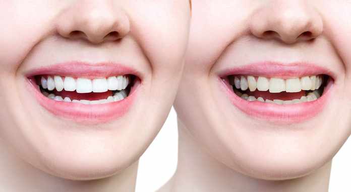 Chipped-Tooth-2-1080x593 Teeth Chipping